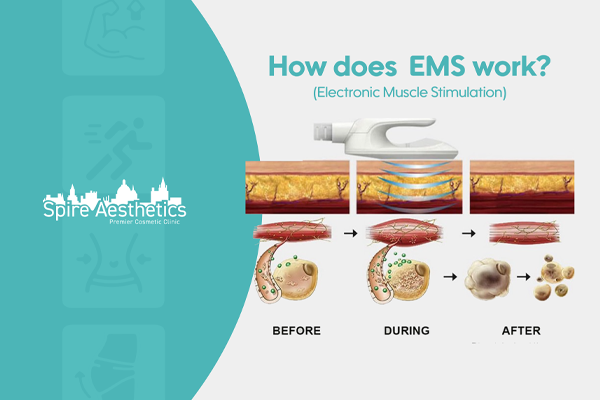 EMS treatment for post pregnancy weight loss treatment Sunninghill