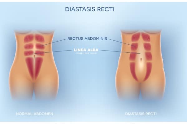 What Non-Surgical Options Are Available for Diastasis Recti Sunninghill?