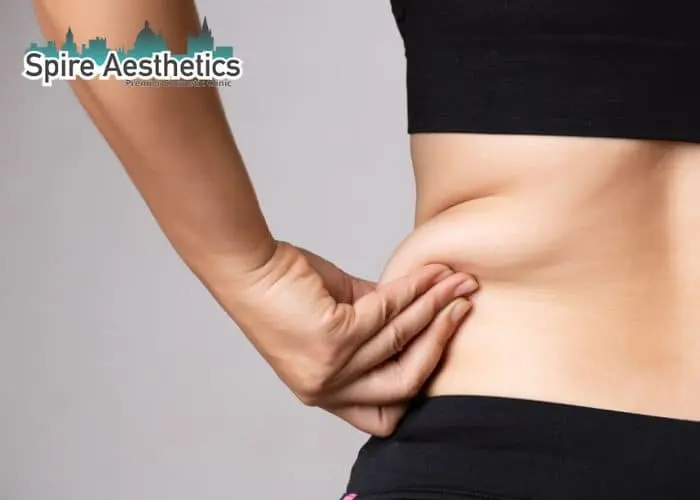 Image of woman pinching fat on their hips Sunninghill. Fat Freezing treatment