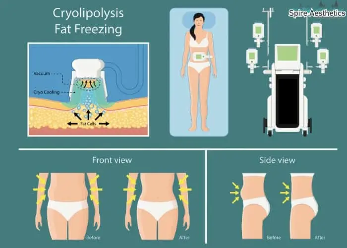 Fat freezing treatment Sunninghill benefits for competitions to remove stubborn fat deposits.