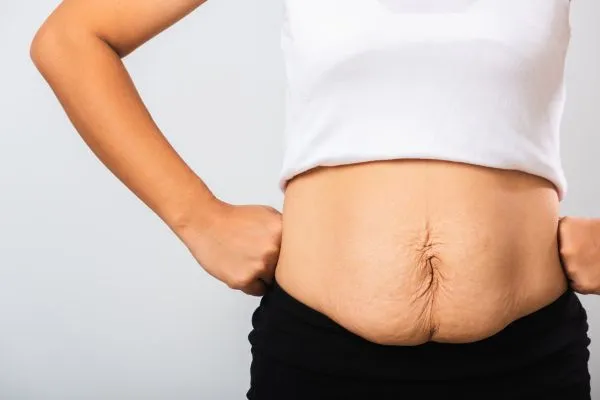 Image of a woman's stomach after weight loss with sagging skin following a gastric band Sunninghill