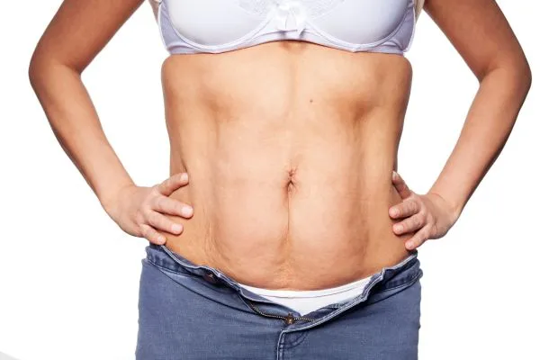 sagging skin on woman's stomach after weight loss injections Sunninghill
