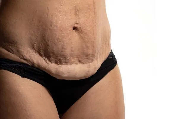 Image of womans stomach after weight loss injections Sunninghill showing saggy skin