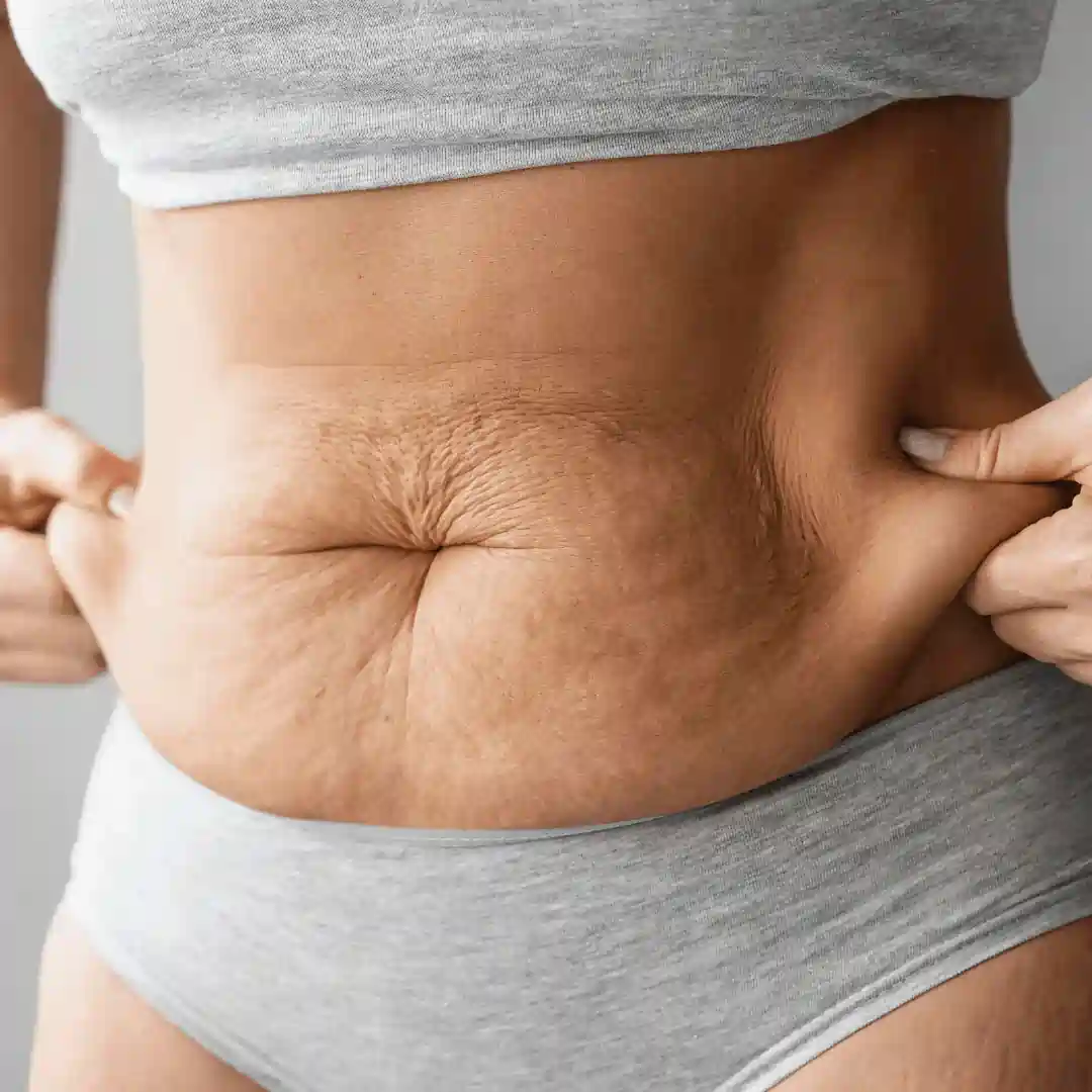 Is It Normal to Have Loose Skin After Pregnancy Sunninghill?