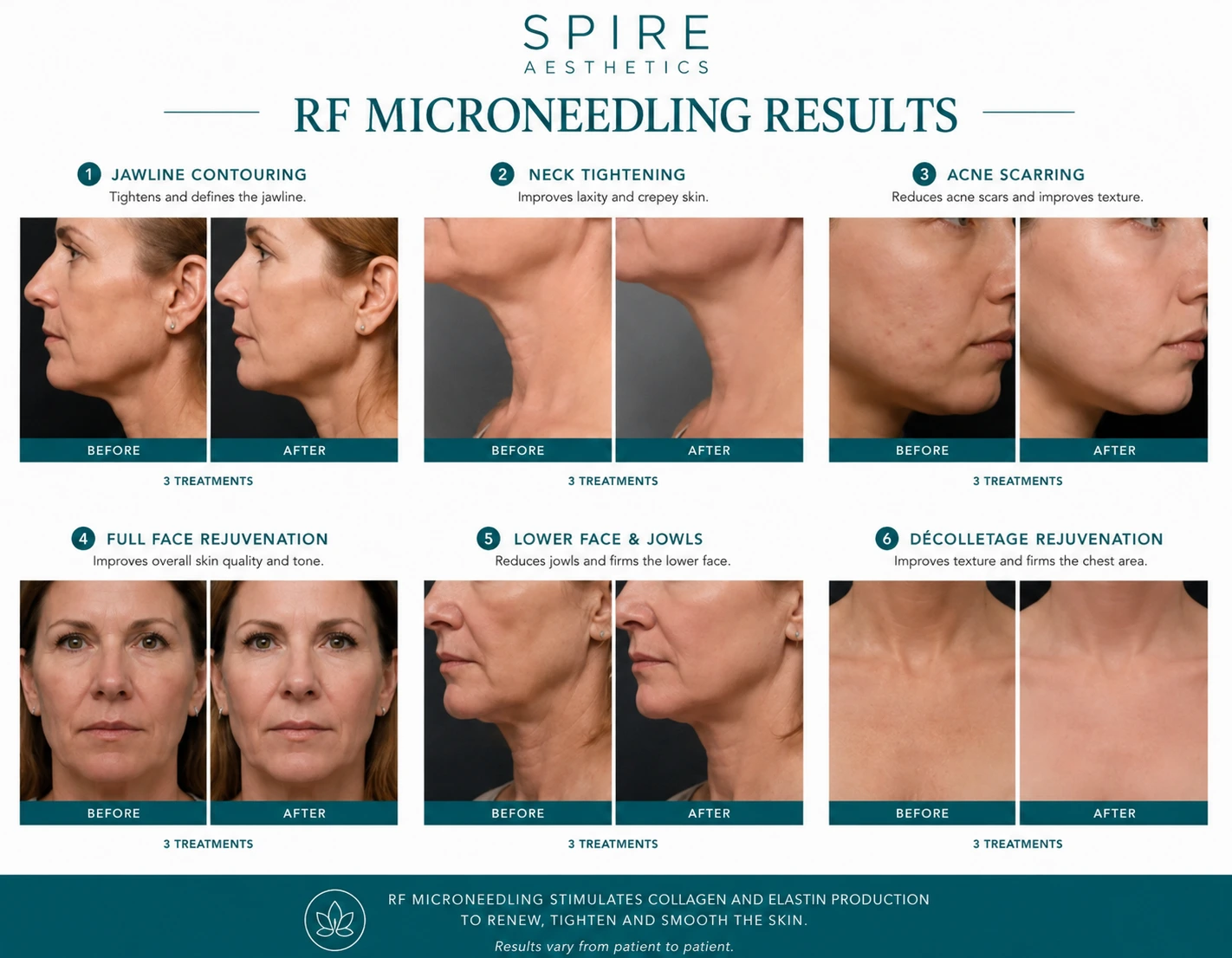 RF Microneedling Skin tightening Sunninghill results