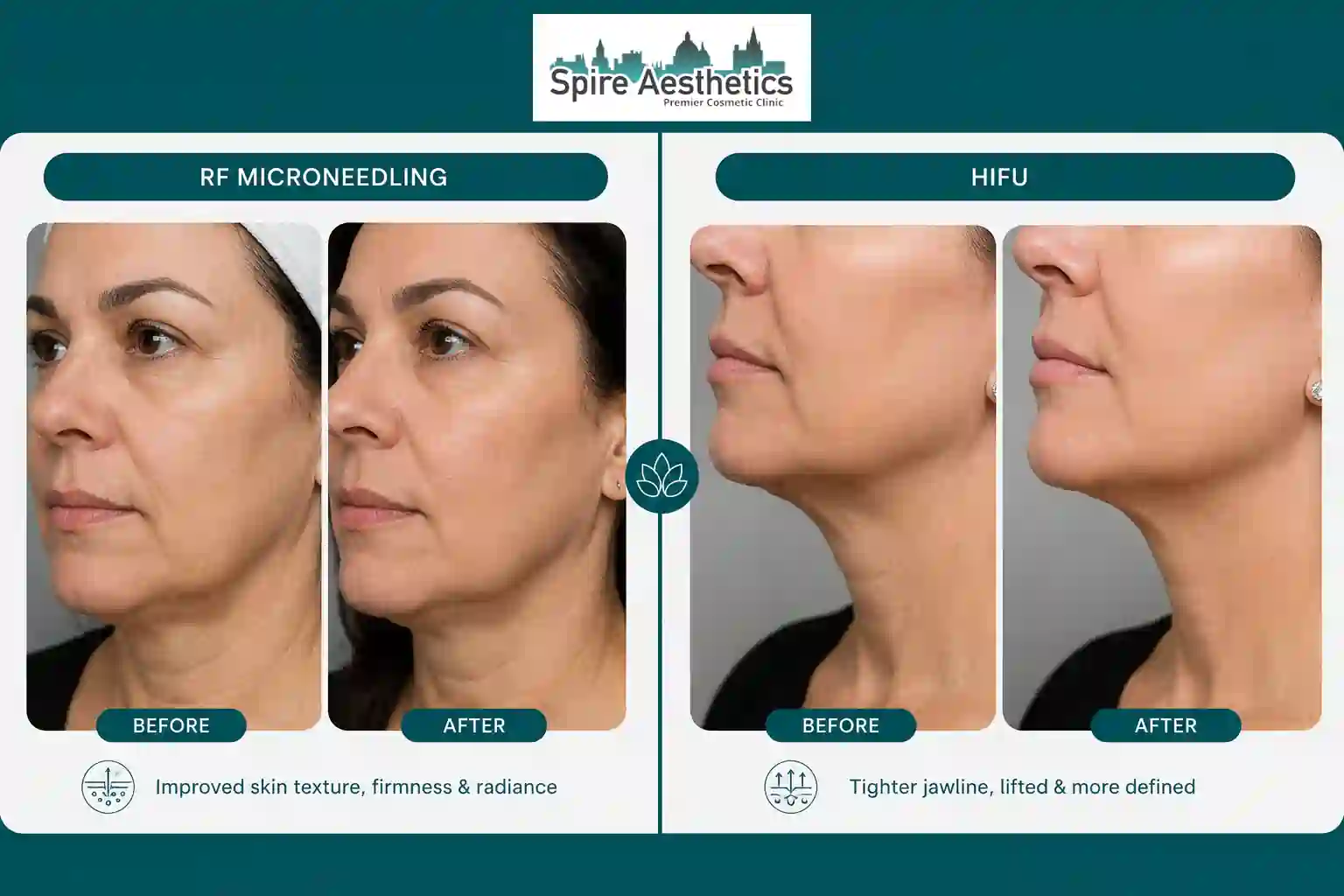 Can RF Microneedling and HIFU Be Combined Sunninghill?