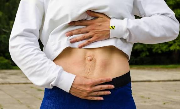 When Could Diastasis Recti Be the Missing Piece of the Puzzle Sunninghill?