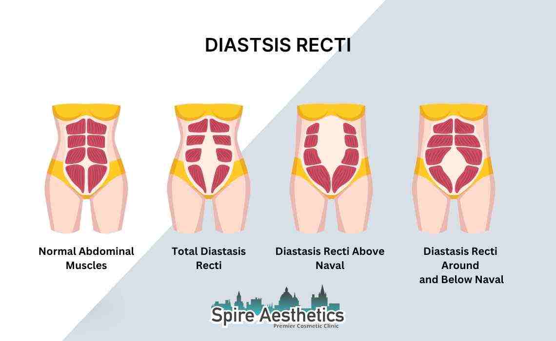 Is Non-Surgical Diastasis Recti Treatment Right for You? Common Concerns Answered Sunninghill